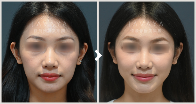 肉毒注射斜方肌｜見證案例_03